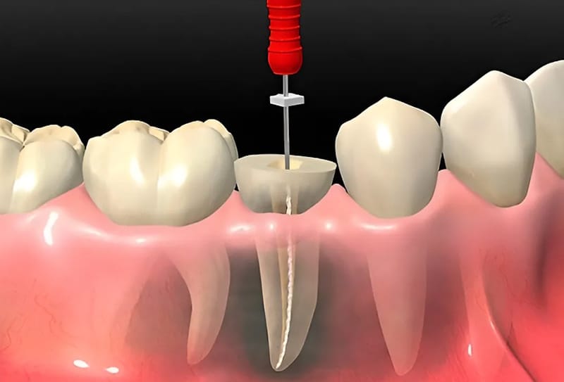 Резекція верхівки кореня зуба